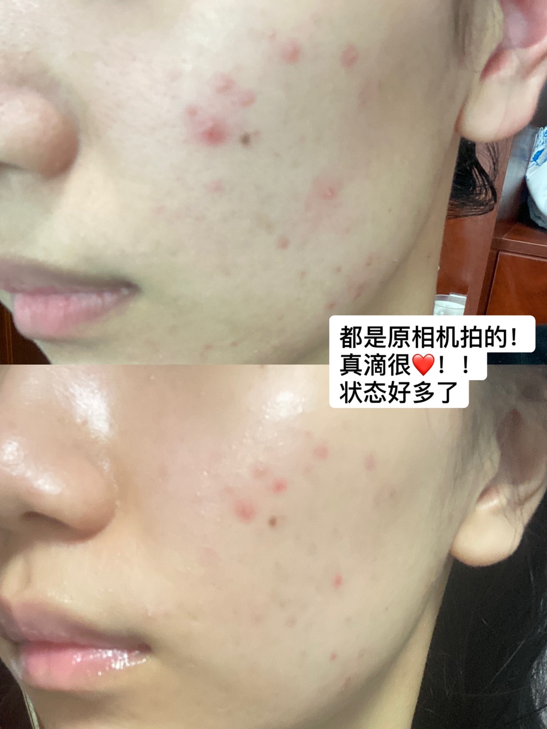 烂脸的痛谁懂😢没你活不下去