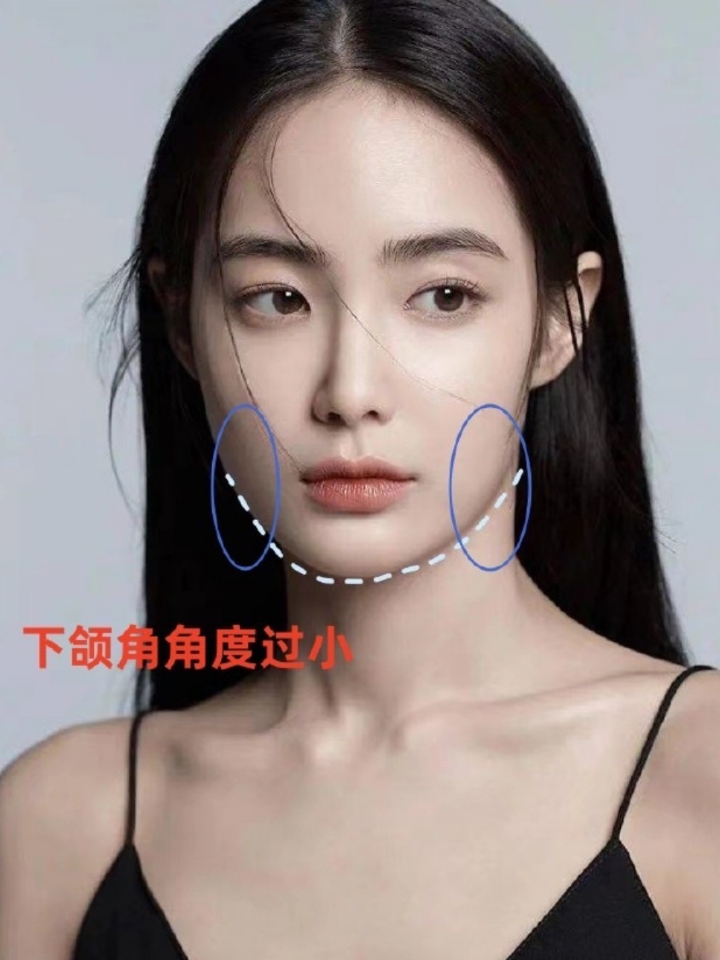下颌角角度对于外轮廓的影响