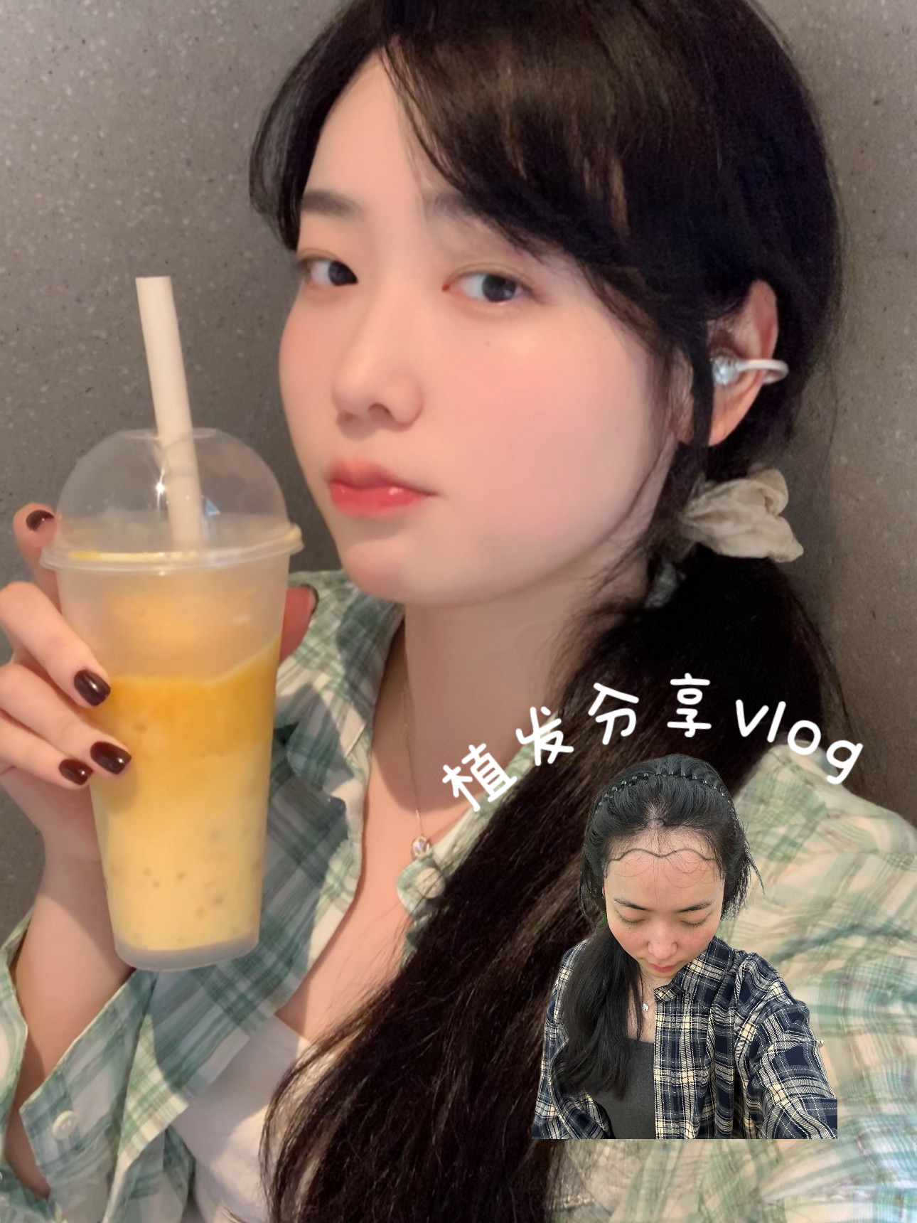 mini Vlog🦋关于我植发17个月后的对比分享