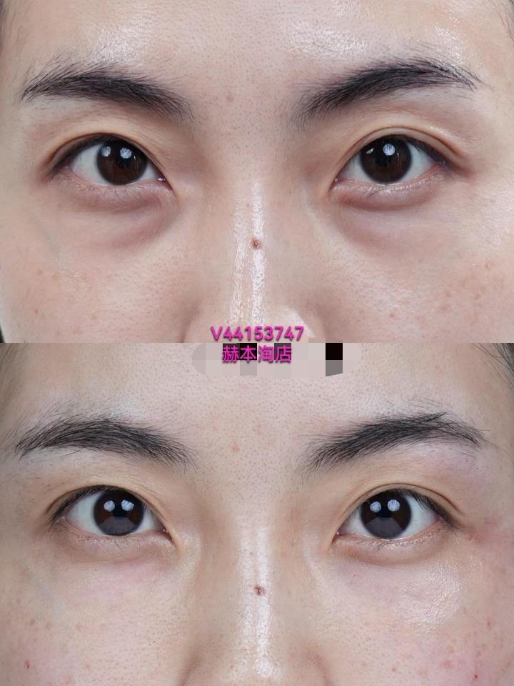 泪沟填充  同样的眼睛，只是改善了泪沟，整个人的状态就完全不一样👀  💉精准填充凹陷部位，衔接眼周与苹果肌，改善泪沟、黑眼圈视觉感，让眼神更明亮、更有精神。  ✅ 不改变五官 ✅ 不夸张、不肿胀 ✅ 自然年轻，像睡饱了一样
