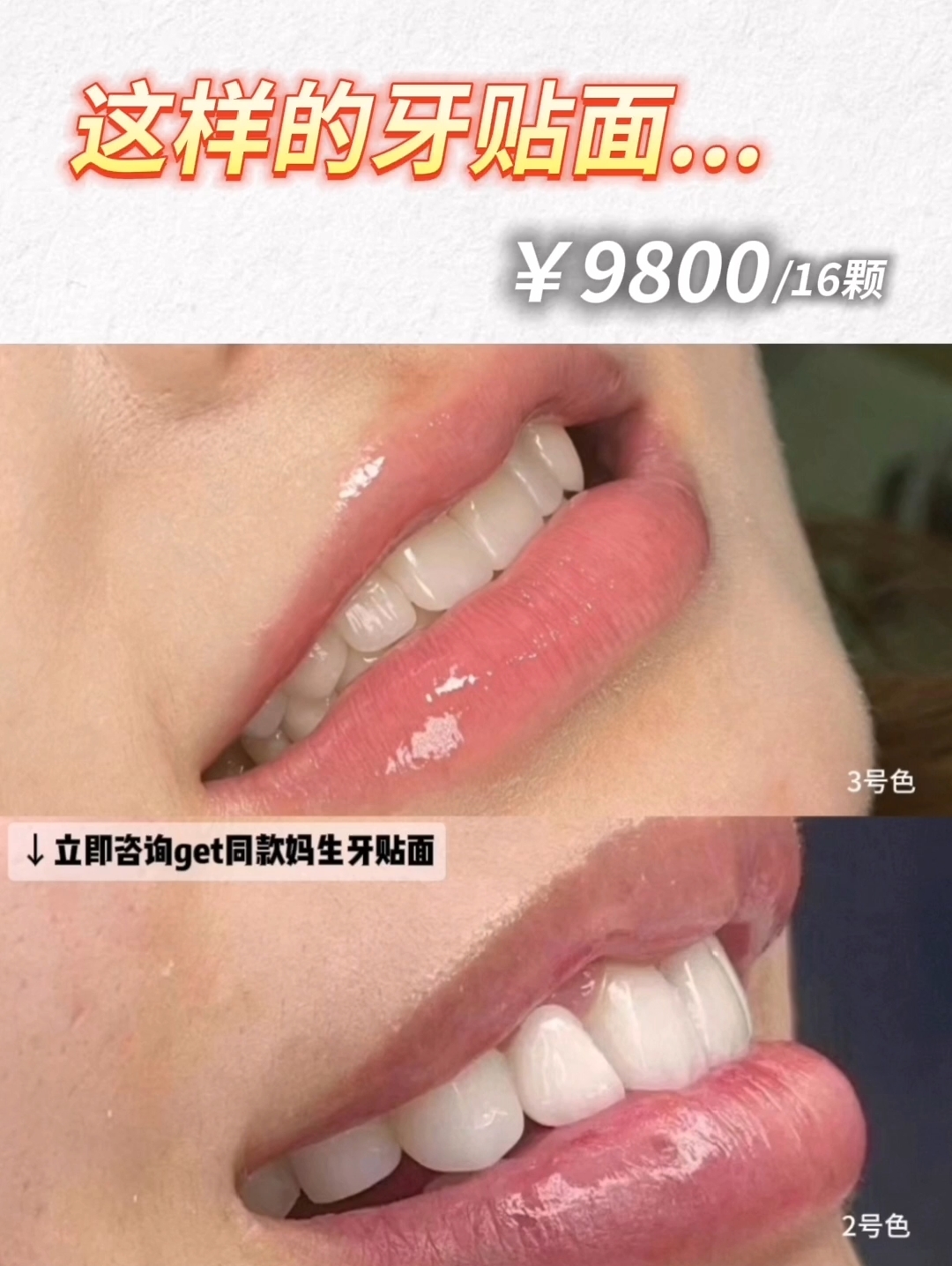 全瓷贴面  ￥9800/16颗！！！